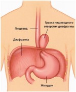 Грыжи пищеводного отверстия диафрагмы